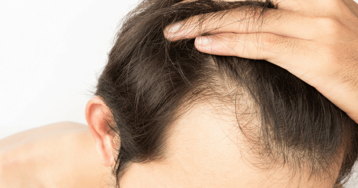 Hair Transplant