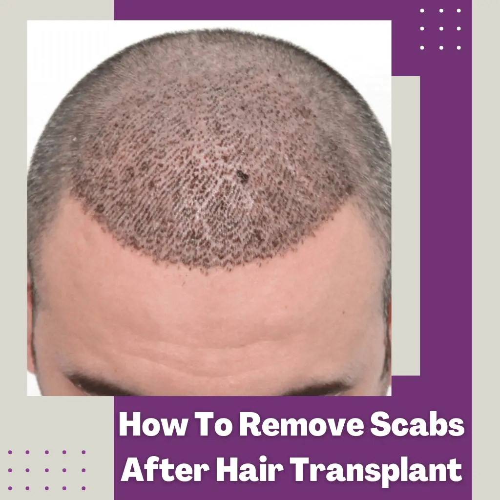How-To-Remove-Scabs-After-Hair-Transplant