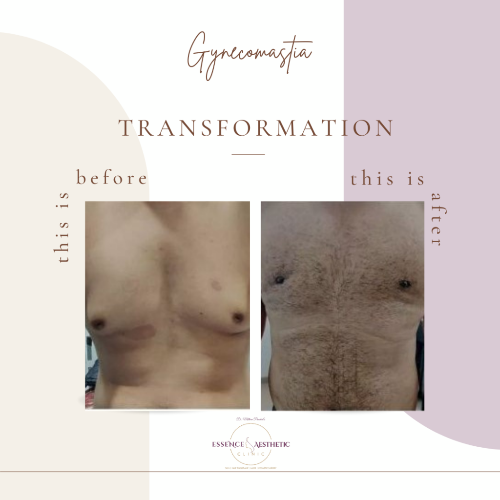 Gynecomastia Customer before and after Instagram Post (3)
