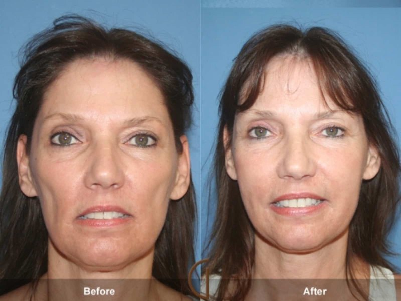 What-is-a-Liquid-Facelift