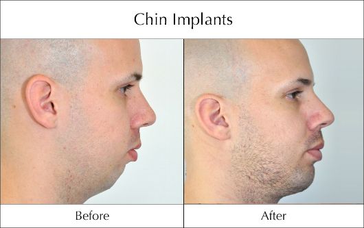 chin-implants-before-and-after-4
