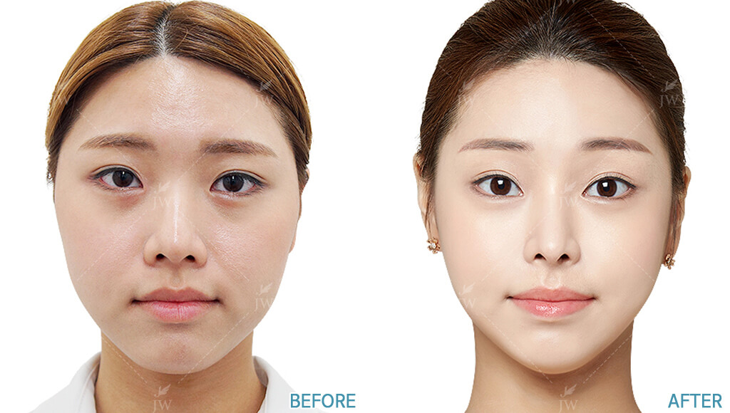 facial-bone-contouring-Cheekbone-Reduction-Square-Jaw-Reduction-Endoforehead-Lifting-Rhinoplasty_1c (1)