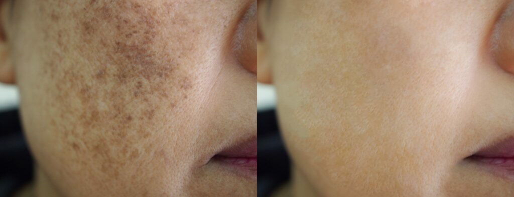 pigmentation-laser-treatment-before-after-2048x788 (1)