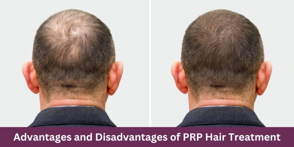 Advantages and Disadvantages of prp Hair Treatment