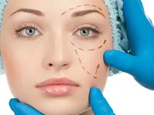 facelift-surgery-in-guwahati-500x500