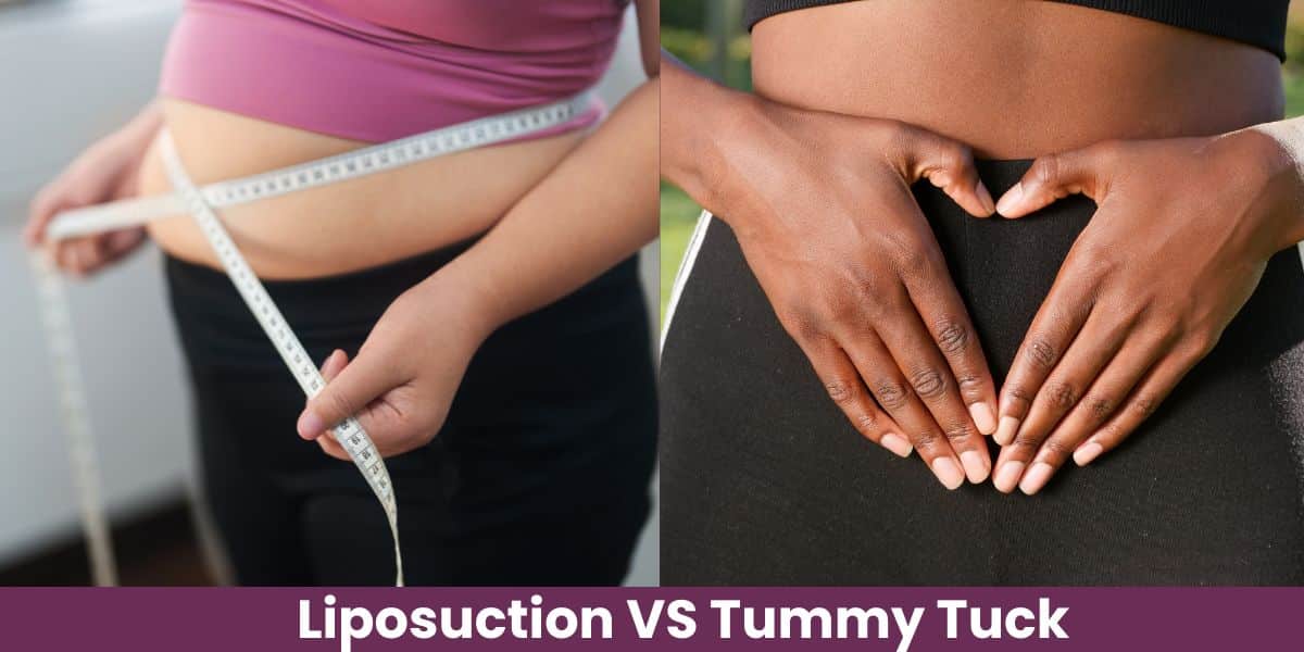 liposuction vs tummy tuck