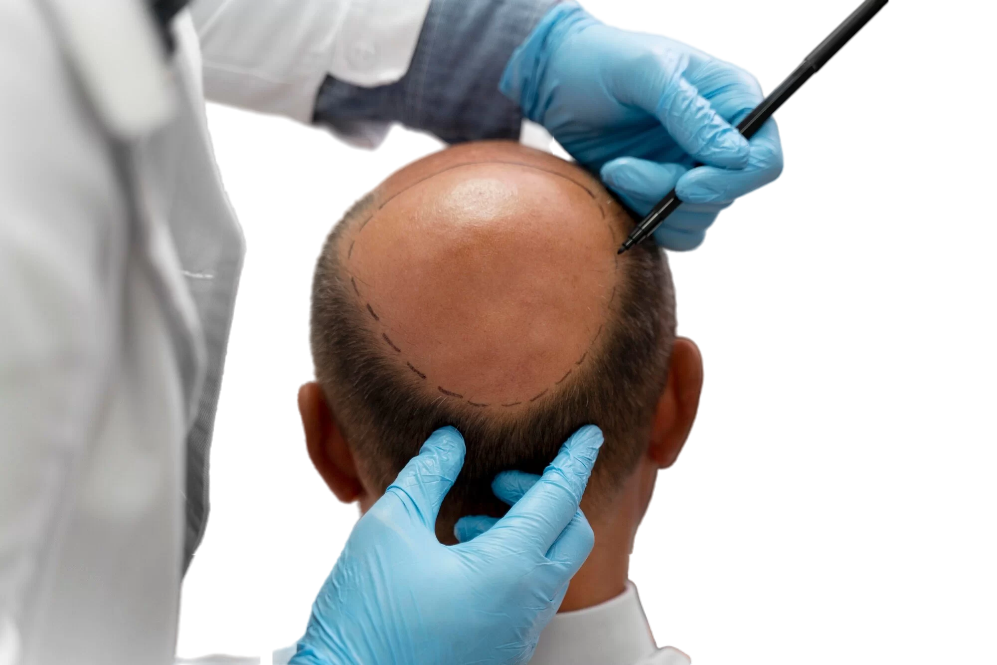 hair transplant treatment