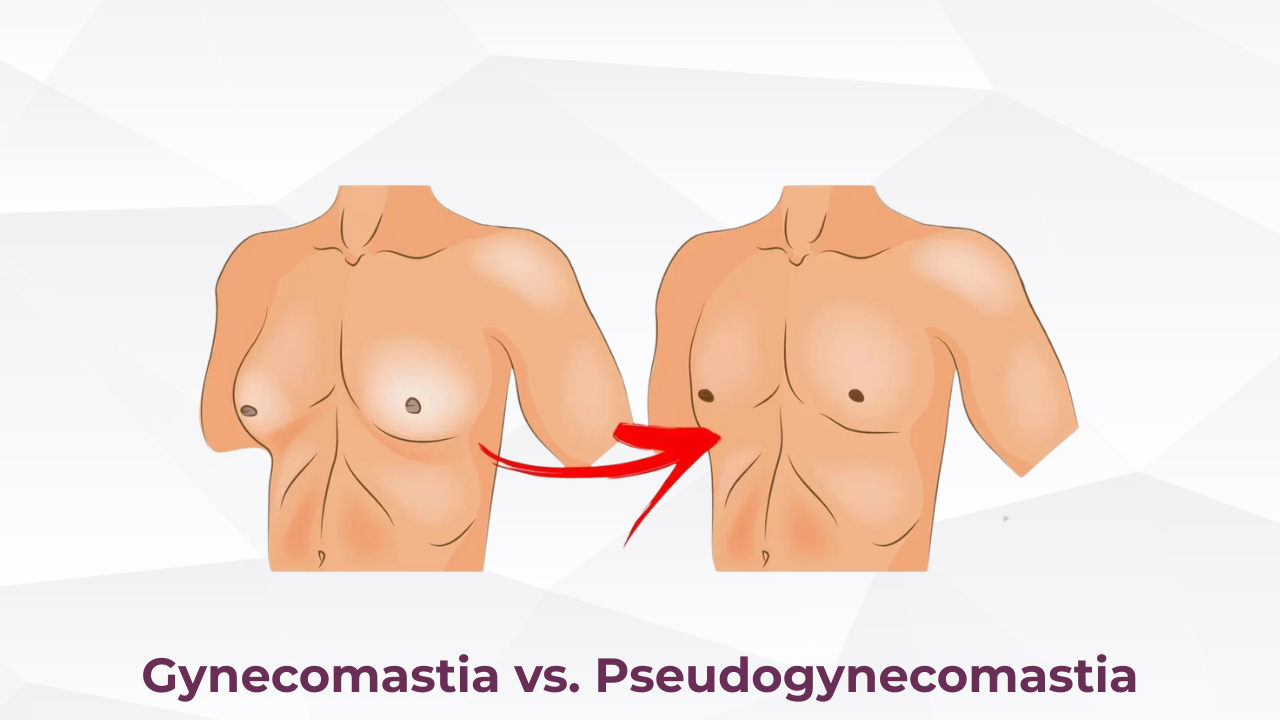 Gynecomastia vs. Pseudogynecomastia
