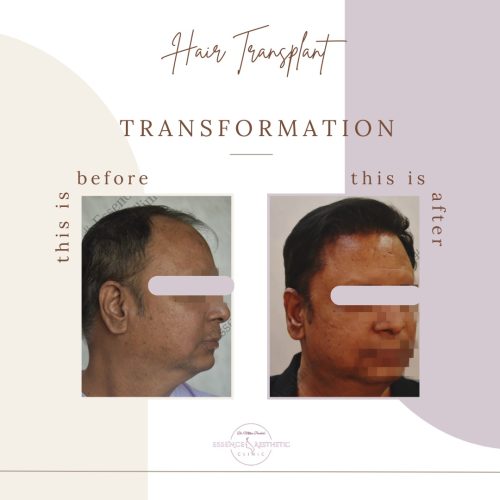 Hair Transplant Before After