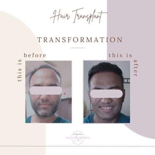 Hair Transplant Before After
